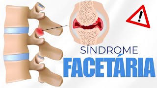 SÍNDROME FACETÁRIA VOCÊ sabe OQUE É [upl. by Harden]