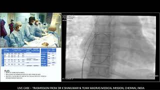 1011 Fenestrated Atrial Septal device Closure device closure in severe Pulmonary Hypertension [upl. by Binny468]