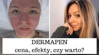 DERMAPEN  MEZOTERAPIA MIKROIGŁOWA  GENEO [upl. by Ssor]