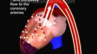 Cardiogenic Shock and Intraaortic Balloon Pump by Dr Cal Shipley MD [upl. by Nertie11]