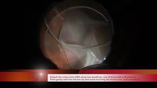 Step by step RPEChoroid graft vitrectomy surgery [upl. by Schlessel]