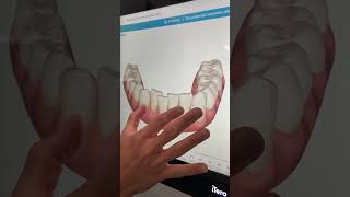 Invisalign Consultation for Busy Professional Before and After Digital Scan Smile Simulation [upl. by Tarrsus]