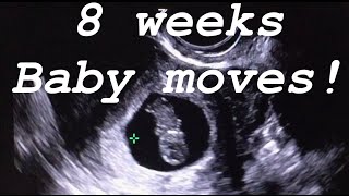 8 weeks ultrasound Baby moves [upl. by Courcy]