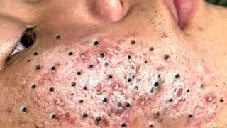 Blackhead Removal With Sac Dep Spa 100074085 [upl. by Hahnert]