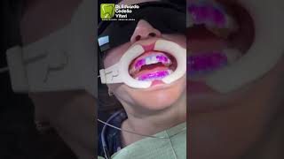 Blanqueamiento Dental con peróxido de hidrógeno y luz LED Paciente satisfecha [upl. by Macguiness]