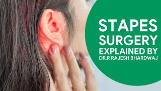 Stapes Surgery For Hearing Loss  Explained By Dr Major Rajesh Bhardwaj entspecialist [upl. by Kori]