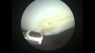 Knee Arthroscopy  Condromalacia Patella amp Partial Lateral Release [upl. by Ziza]