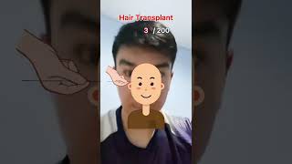 Hair transplant stickman animation [upl. by Ylrae]