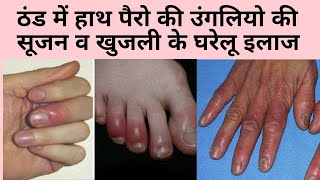 ठंड में हाथ पैरो की उंगलियों में सूजन व खुजली के घरेलू इलाज। home remedy for chilblains [upl. by Sachi]