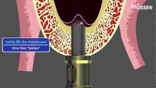 OSSTEM  HIOSSEN CASKit Crestal Approach Sinus Kit [upl. by Notffilc]