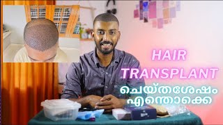 After hair transplant ആദ്യത്തെ ദിവസങ്ങൾ  safvan pullara [upl. by Ineslta206]