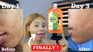 How to use DETTOL antiseptic liquid to clear acne  DETTOL for face acne  safetips [upl. by Matilde65]