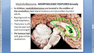 Pathology 897 a Medulloblastoma brain Homer Wright psuedorosettes Drop metastases child tumor cauda [upl. by Humfrid]