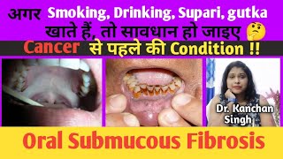 Osmf treatment in hindi Oral submucous fibrosis cause and treatment Dr Kanchan Singh [upl. by Ymar]