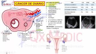 Ginecología  4 Cáncer de Ovario [upl. by Ermin]