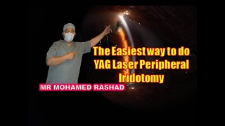 The easiest way to do Laser Peripheral Iridotomy علاج الجلوكوما الحادة و إنسداد زاوية العين بالليزر [upl. by Jaworski]