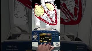 Atrial Fibrillation Cardioversion Video and Animation 🫀🔌 medical cardiology [upl. by Yorker925]