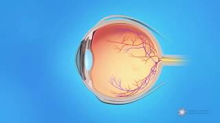 What is central retinal vein occlusion CRVO [upl. by Bigelow]