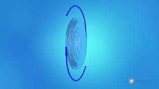 What is a multifocal toric intraocular lens IOL [upl. by Thesda]