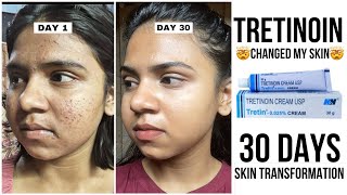 My 30 Days Tretinoin Journey  How to use Tretinoin correctly for glass skin  NO purgingsideeffect [upl. by Karp]