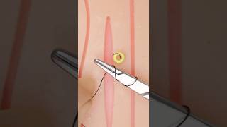 Sutures for Thin Skin surgery stitches suturing vet medicine surgeon surgeonlife funfacts [upl. by Seda]