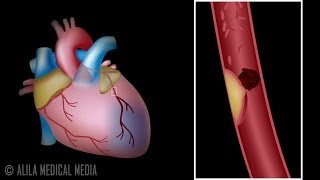 Myocardial Infarction and Coronary Angioplasty Treatment Animation [upl. by Timothea748]