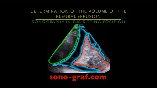 Sonography  Determination of the volume of the pleural effusion [upl. by Ettedo838]