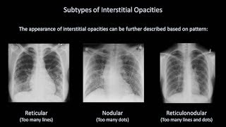 How to Interpret a Chest XRay Lesson 7  Diffuse Lung Processes [upl. by Oninrutas]