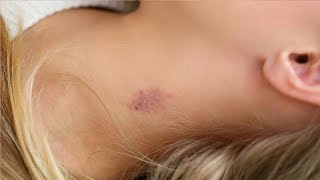 how to do love bites step by step on the neck [upl. by Sholem]