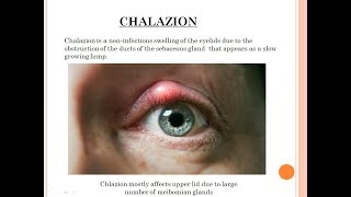 Diseases of Eyelid 1 Chalazion ophthalmology by JD [upl. by Jacy250]