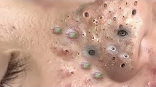 Big Cystic Acne Blackheads Extraction Blackheads amp Milia Whiteheads Removal Pimple Popping  4143 [upl. by Assilim918]