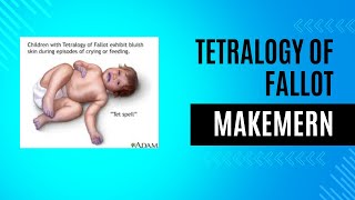 Tetralogy of Fallot [upl. by Lunt]