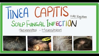 Tinea Capitis fungal infection of scalp causes transmission clinical features and Treatment [upl. by Llertac]