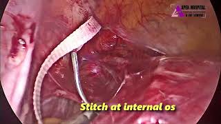 Laparoscopic Abdominal Cerclage by Dr R K Mehta  Apex Hospital Sirsa [upl. by Doralin]