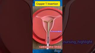 IUD insertionCopper T insertion  Intrauterine device iucd iud iudinsertioncopperiudshorts [upl. by Jp]