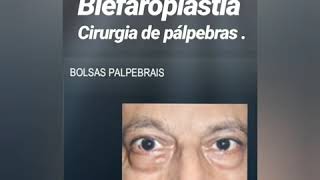 Cirurgia da pálpebra  blefaroplastia [upl. by Bohs]