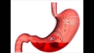 Upper Gastrointestinal Bleeding  Cause and Management [upl. by Halil]