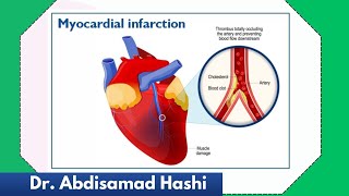 82 MYOCARDIAL INFARCTION [upl. by Ahasuerus]