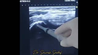 intraarticular Knee injection for OA knee joint by Dr Sairah Sadaf [upl. by Atrebla]