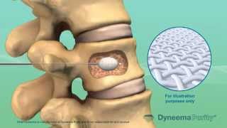 Cement Vertebroplasty  Medical Animation by Watermark [upl. by Luna]