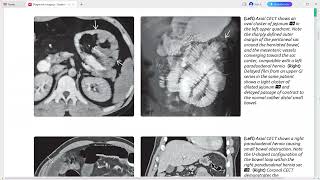 Peritoneum mesentery and abdominal wall imaging [upl. by Anayik]