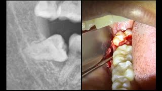 Extracción MUELA DEL JUICIO horizontal  Extracción de cordal incluido [upl. by Llennehc]