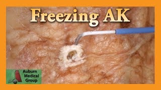 Freezing Hand Actinic Keratosis with Liquid Nitrogen  Auburn Medical Group [upl. by Odnanreh]