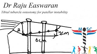 Tibial tubercle osteotomy TTO [upl. by Outhe751]