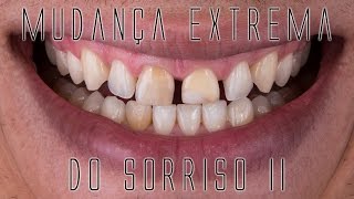 Mudança extrema do sorriso II Os bastidores das facetas e lentes de contato dentais [upl. by Eninahs390]