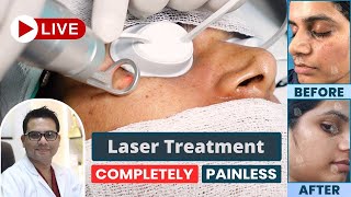 Freckles Laser Treatment  Best Freckles Laser Treatment in Delhi NCR  SkinQure  Dr Jangid [upl. by Bible]