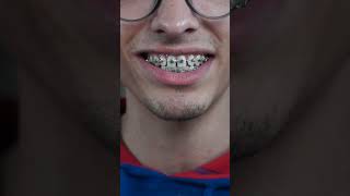 Watch How I Got My Braces Installed [upl. by Adnirol469]