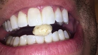 Most dangerous Tonsil stone removal [upl. by Peg]