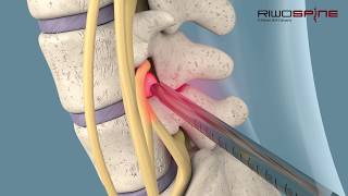 Fullendoscopic spinal treatment of herniated discs and spinal canal stenosis [upl. by Nwahsauq]