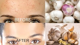 Remove Forehead Pimples Overnight  Acne Treatment with Garlic [upl. by Waldack877]